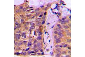 Immunohistochemical analysis of 14-3-3 zeta staining in human breast cancer formalin fixed paraffin embedded tissue section. (14-3-3 zeta 抗体  (Center))
