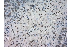 Immunohistochemical staining of paraffin-embedded Adenocarcinoma of colon tissue using anti-NTRK3mouse monoclonal antibody. (NTRK3 抗体)