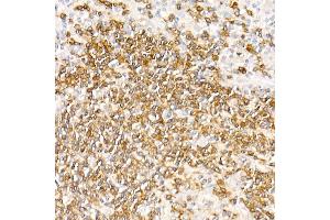 Immunohistochemistry of paraffin-embedded Human nodular Hodgkin lymphoma using CD79a antibody (ABIN7265805) at dilution of 1:100 (40x lens). (CD79a 抗体)