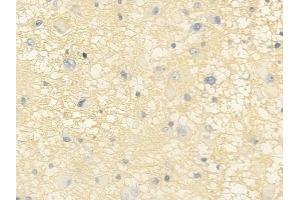 ABIN6257174 and ABIN6275113 at 1/100 staining human astrocytoma by IHC-P. (Epsin 2 抗体  (Internal Region))