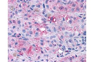 Anti-GRM4 / MGLUR4 antibody IHC of human Skin, Melanoma. (Metabotropic Glutamate Receptor 4 抗体  (N-Term))