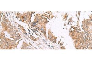 Immunohistochemistry of paraffin-embedded Human colorectal cancer tissue using HLA-E Polyclonal Antibody at dilution of 1:50(x200)