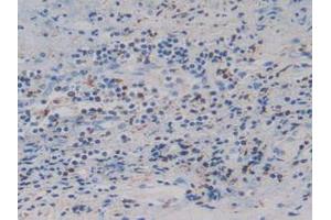 IHC-P analysis of Human Prostate Gland Cancer Tissue, with DAB staining. (IGFBP4 抗体  (AA 22-258))