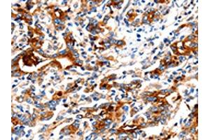 The image on the left is immunohistochemistry of paraffin-embedded Human gastric cancer tissue using ABIN7130018(KLK15 Antibody) at dilution 1/15, on the right is treated with fusion protein. (Kallikrein 15 抗体)