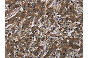 The image on the left is immunohistochemistry of paraffin-embedded Human liver cancer tissue using ABIN7191253(LAIR2 Antibody) at dilution 1/20, on the right is treated with synthetic peptide. (LAIR2 抗体)