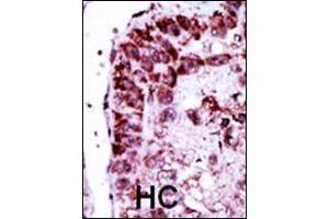 Formalin-fixed and paraffin-embedded human cancer tissue reacted with the primary antibody, which was peroxidase-conjugated to the secondary antibody, followed by DAB staining. (Adenylate Kinase 2 抗体  (N-Term))