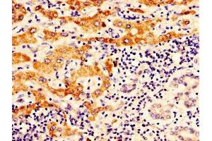 IHC image of ABIN7162288 diluted at 1:400 and staining in paraffin-embedded human liver cancer performed on a Leica BondTM system. (OTC 抗体  (AA 33-354))