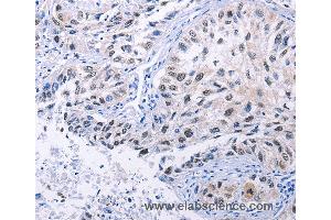 Immunohistochemistry of Human lung cancer using HMGB3 Polyclonal Antibody at dilution of 1:20 (HMGB3 抗体)