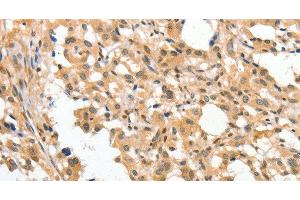 Immunohistochemistry of paraffin-embedded Human thyroid cancer tissue using APTX Polyclonal Antibody at dilution 1:50 (Aprataxin 抗体)