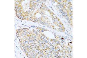 Immunohistochemistry of paraffin-embedded human colon carcinoma using LYZ antibody (ABIN5975352) at dilution of 1/100 (40x lens). (LYZ 抗体)