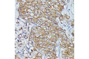 Immunohistochemistry of paraffin-embedded human mammary cancer using Cortactin antibody  at dilution of 1:100 (40x lens). (Cortactin 抗体  (AA 1-200))