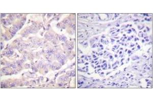 Immunohistochemistry analysis of paraffin-embedded human colon carcinoma tissue, using c-PLA2 (Ab-505) Antibody. (C-PLA2 (AA 471-520) 抗体)
