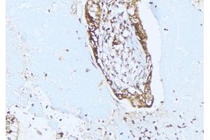 ABIN6275353 at 1/100 staining Human lung cancer tissue by IHC-P. (PEX10 抗体  (Internal Region))