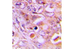 Immunohistochemical analysis of RPL18 staining in human lung cancer formalin fixed paraffin embedded tissue section. (RPL18 抗体  (Center))
