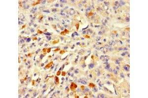 Immunohistochemistry of paraffin-embedded human melanoma using ABIN7143055 at dilution of 1:100 (Actin-Like 7A 抗体  (AA 1-435))