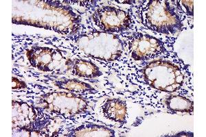 Formalin-fixed and paraffin embedded human colon carcinoma labeled with Anti-GDNFRA Polyclonal Antibody, Unconjugated  at 1:200 followed by conjugation to the secondary antibody and DAB staining. (GFRA1 抗体  (AA 351-429))