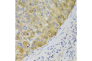 Immunohistochemistry of paraffin-embedded human liver cancer using PA2G4 Antibody. (PA2G4 抗体  (AA 1-394))