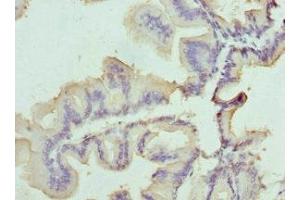 Immunohistochemistry of paraffin-embedded human prostate cancer using ABIN7159841 at dilution of 1:100