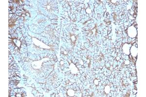 Formalin-fixed, paraffin-embedded human Colon stained with Cadherin 17 / CDH17 Mouse Monoclonal Antibody (CDH17/2617). (LI Cadherin 抗体  (AA 242-418))