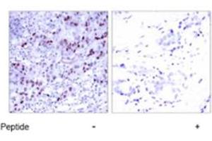 Immunohistochemical analysis of paraffin-embedded human breast carcinoma tissue using GATA1 polyclonal antibody . (GATA1 抗体  (Ser142))
