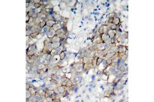 Immunohistochemistry of paraffin-embedded human breast carcinoma using Phospho-IGF1R-Y1161 antibody (ABIN2988064). (IGF1R 抗体  (pTyr1161))