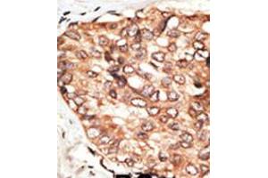 Formalin-fixed and paraffin-embedded human cancer tissue reacted with the primary antibody, which was peroxidase-conjugated to the secondary antibody, followed by DAB staining.