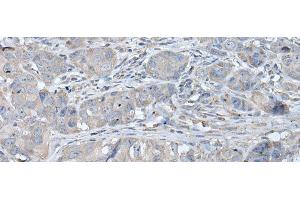 Immunohistochemistry of paraffin-embedded Human breast cancer tissue using RASA1 Polyclonal Antibody at dilution of 1:40(x200) (RASA1 抗体)