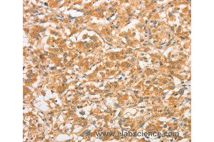 Immunohistochemistry of Human gastric cancer using TLR3 Polyclonal Antibody at dilution of 1:50 (TLR3 抗体)