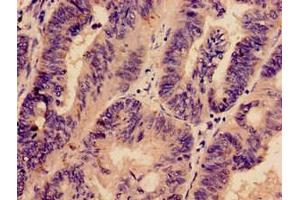 Immunohistochemistry analysis of human colon cancer using ABIN7163177 at dilution of 1:100 (PREX1 抗体  (AA 1-44))