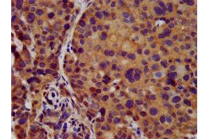 IHC image of ABIN7145029 diluted at 1:500 and staining in paraffin-embedded human pancreatic cancer performed on a Leica BondTM system. (KCNJ8 抗体  (AA 299-424))