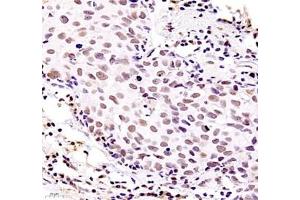 Immunohistochemistry of paraffin embedded human breast cancer using ZKSCAN4 (ABIN7076265) at dilution of 1:400 (400x lens) (ZKSCAN4 抗体)