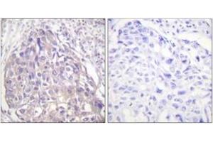 Immunohistochemistry analysis of paraffin-embedded human breast carcinoma, using FOXO1/3/4-pan (Phospho-Thr24/32) Antibody. (FOXO1 抗体  (pThr24))