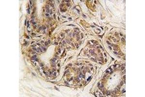 IHC analysis of FFPE human breast carcinoma tissue stained with CASC3 antibody (CASC3 抗体  (AA 159-188))
