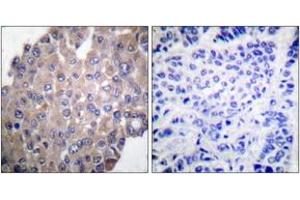 Immunohistochemistry analysis of paraffin-embedded human breast carcinoma, using PLCG1 (Phospho-Tyr771) Antibody. (Phospholipase C gamma 1 抗体  (pTyr771))
