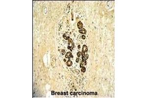 Formalin-fixed and paraffin-embedded human breast carcinoma with ErbB3 Antibody (N-term), which was peroxidase-conjugated to the secondary antibody, followed by DAB staining. (ERBB3 抗体  (N-Term))