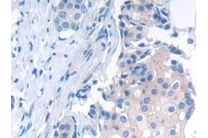Detection of NCAD in Human Breast cancer Tissue using Polyclonal Antibody to N-cadherin (NCAD) (N-Cadherin 抗体  (AA 685-784))