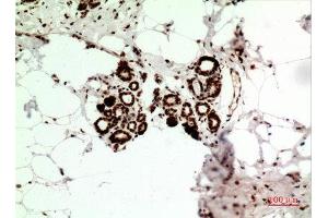 Immunohistochemistry (IHC) analysis of paraffin-embedded Human Breast Cancer, antibody was diluted at 1:100. (HSP70 抗体  (Ser102))