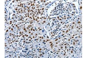 The image on the left is immunohistochemistry of paraffin-embedded Human lung cancer tissue using ABIN7191895(PIWIL3 Antibody) at dilution 1/20, on the right is treated with synthetic peptide. (PIWIL3 抗体)