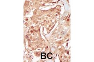 Formalin-fixed and paraffin-embedded human cancer tissue reacted with the primary antibody, which was peroxidase-conjugated to the secondary antibody, followed by DAB staining. (CDK18 抗体  (N-Term))