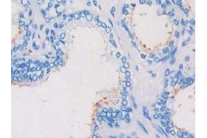 Detection of CRKL in Human Prostate Tissue using Polyclonal Antibody to Crk Like Protein (CRKL) (CrkL 抗体  (AA 1-303))