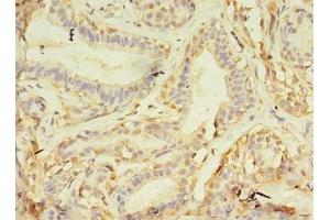 Immunohistochemistry of paraffin-embedded human breast cancer using ABIN7161747 at dilution of 1:100 (NAIF1 抗体  (AA 1-172))