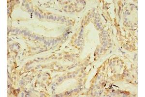 Immunohistochemistry of paraffin-embedded human breast cancer using ABIN7161747 at dilution of 1:100 (NAIF1 抗体  (AA 1-172))