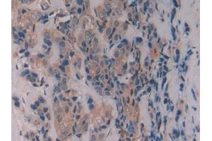 Detection of CAV1 in Human Breast cancer Tissue using Polyclonal Antibody to Caveolin 1 (CAV1) (Caveolin-1 抗体  (AA 2-104))