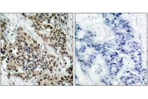 Immunohistochemistry analysis of paraffin-embedded human breast carcinoma, using FKHR (Phospho-Ser256) Antibody. (FOXO1 抗体  (pSer256))