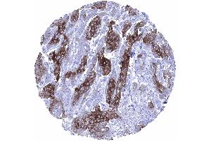 Squamous cell carcinoma with variable Dsg1 staining of tumor cells showing only weak staining at the periphery of tumor cell nests (Desmoglein 1 抗体)