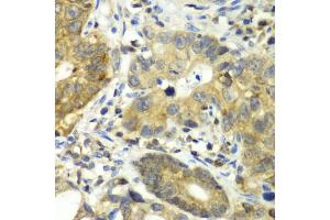 Immunohistochemistry of paraffin-embedded human gastric cancer using DPP3 antibody. (DPP3 抗体)