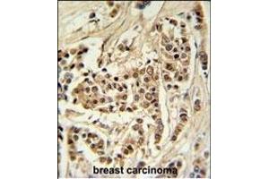 TTL Antibody (C-term) (ABIN651357 and ABIN2840199) IHC analysis in formalin fixed and raffin embedded human breast carcinoma followed by peroxidase conjugation of the secondary antibody and DAB staining. (TTPAL 抗体  (C-Term))