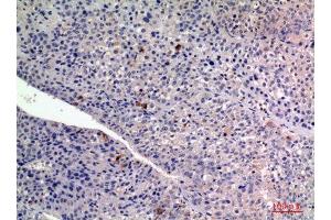 Immunohistochemistry (IHC) analysis of paraffin-embedded Human Liver Cancer, antibody was diluted at 1:100.