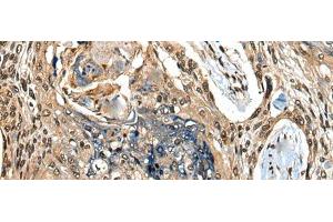 Immunohistochemistry of paraffin-embedded Human esophagus cancer tissue using CAMKK1 Polyclonal Antibody at dilution of 1:35(x200) (CAMKK1 抗体)