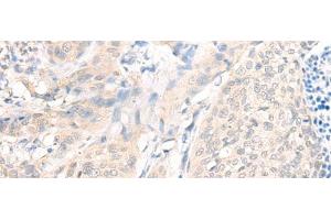Immunohistochemistry of paraffin-embedded Human cervical cancer tissue using AOAH Polyclonal Antibody at dilution of 1:25(x200) (AOAH 抗体)